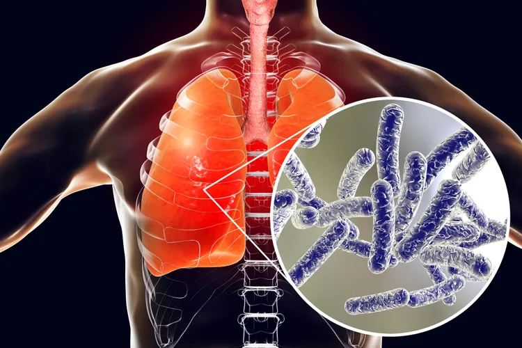 Computer illustration of Legionnaires' disease.Credit : Getty